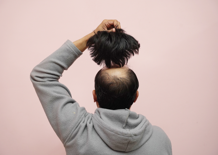 hair-bonding